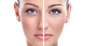 Pregnancy and pigmentation