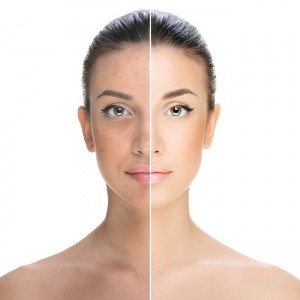 pigmentation