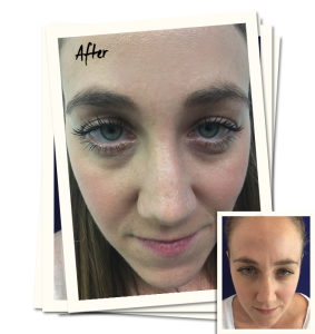 botox-review