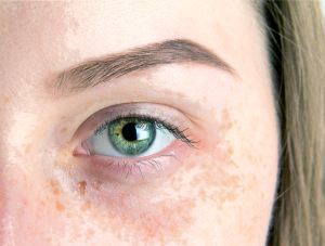 Pigmentation