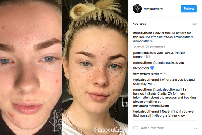 Freckles: From flaws to flawless 2