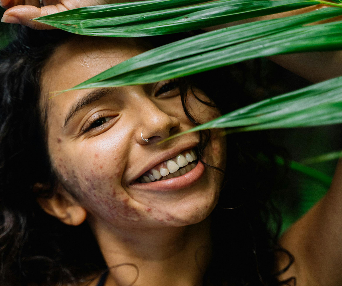 smiling girl with acne on cheek