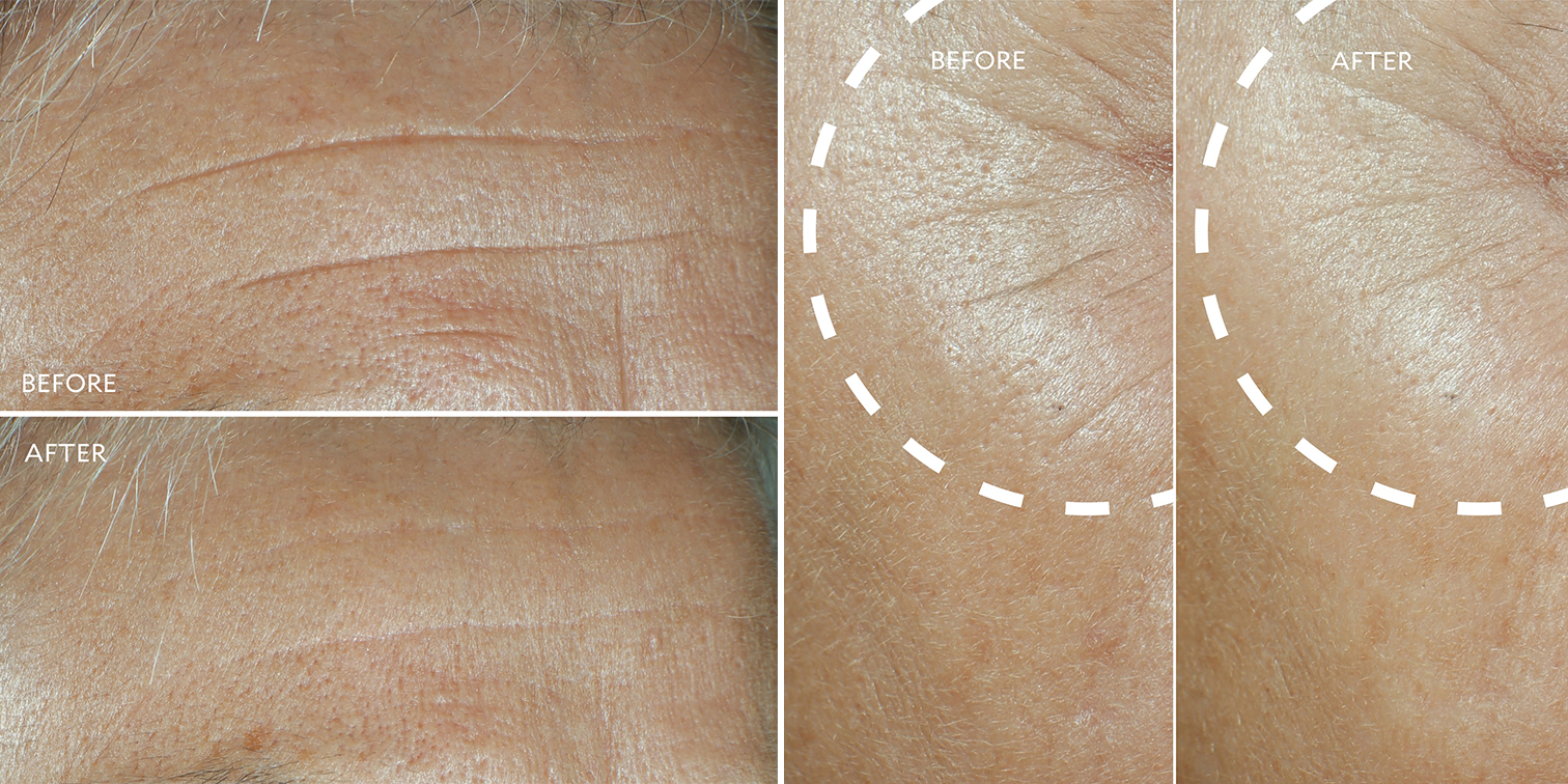 skincare results of defi lift